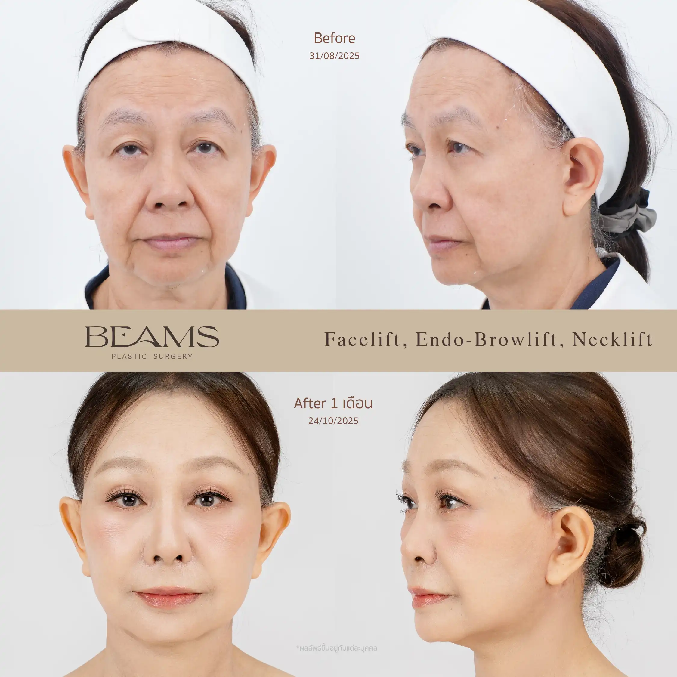 รีวิวดึงหน้า