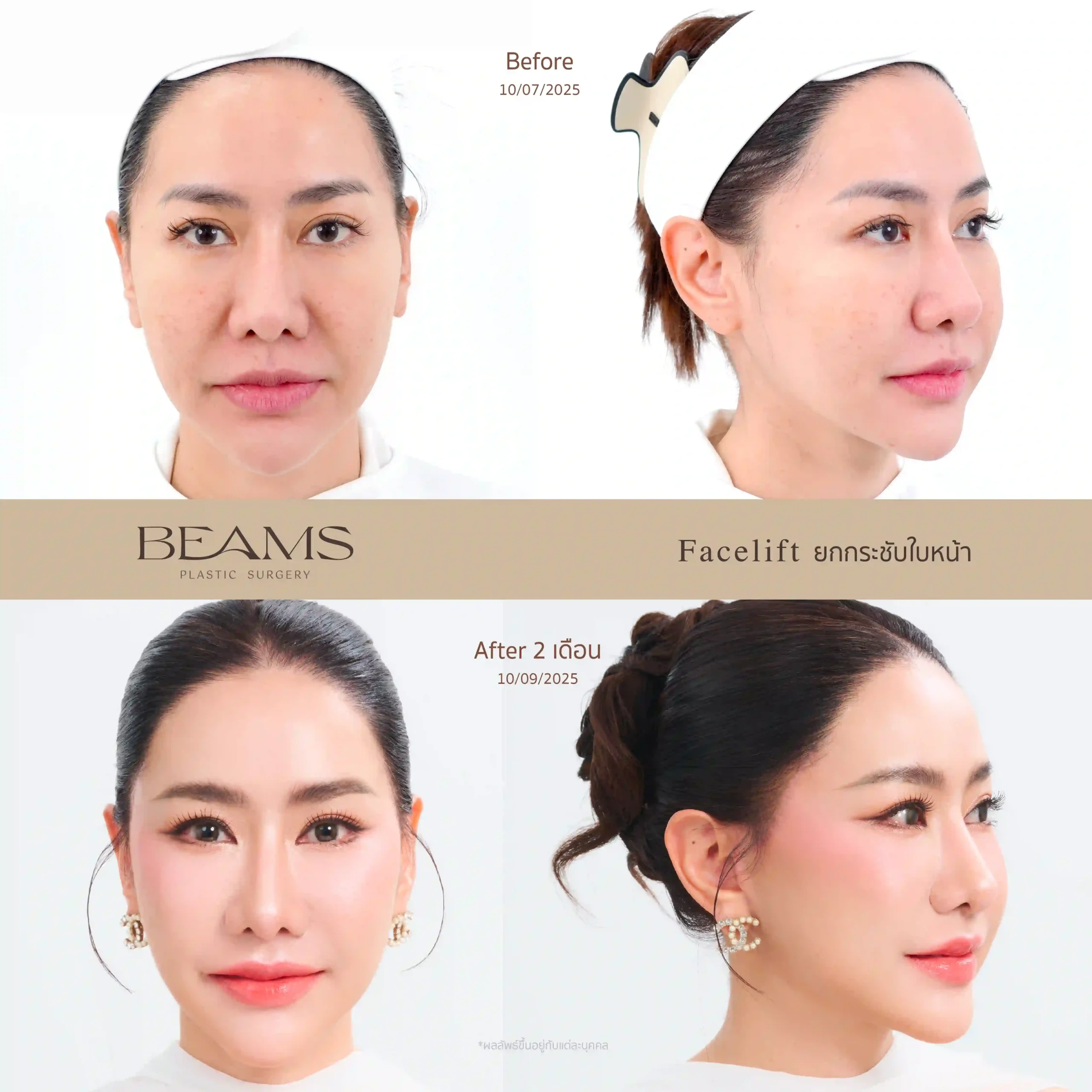 รีวิวดึงหน้า