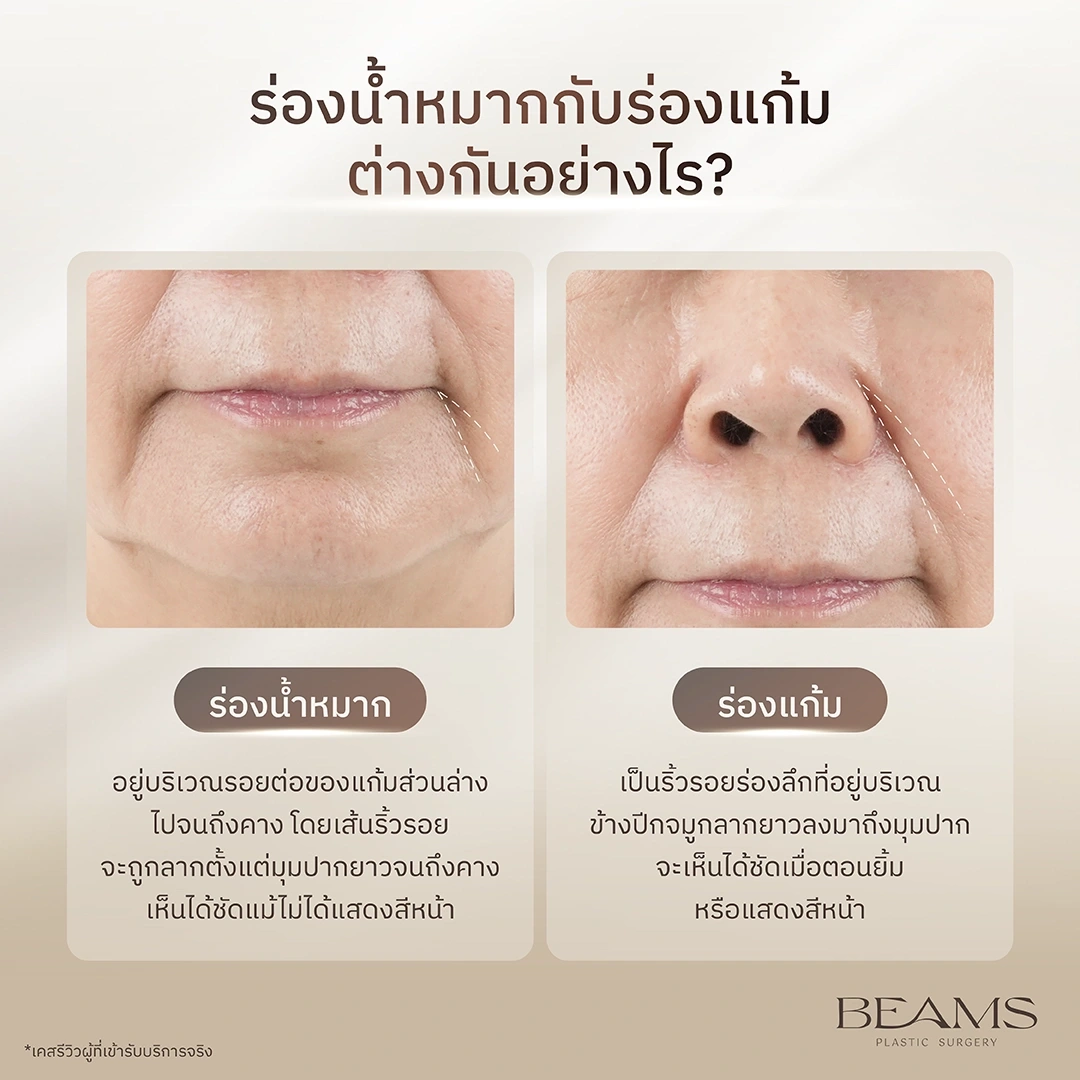 ร่องน้ำหมากกับร่องแก้มต่างกันอย่างไร