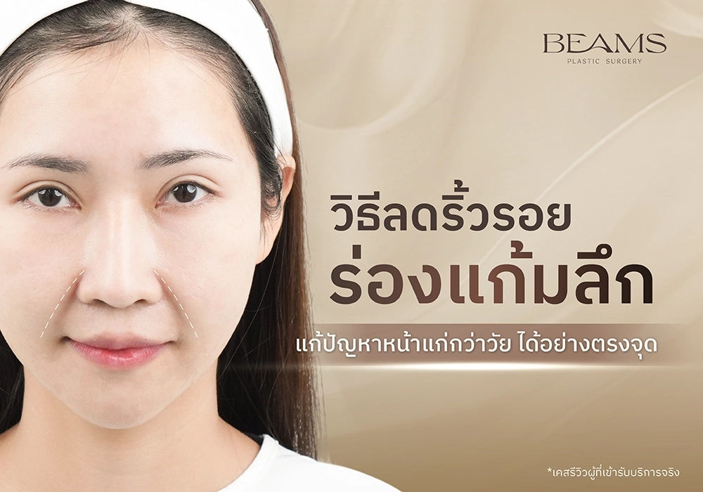 วิธีลดริ้วรอยร่องแก้มลึก