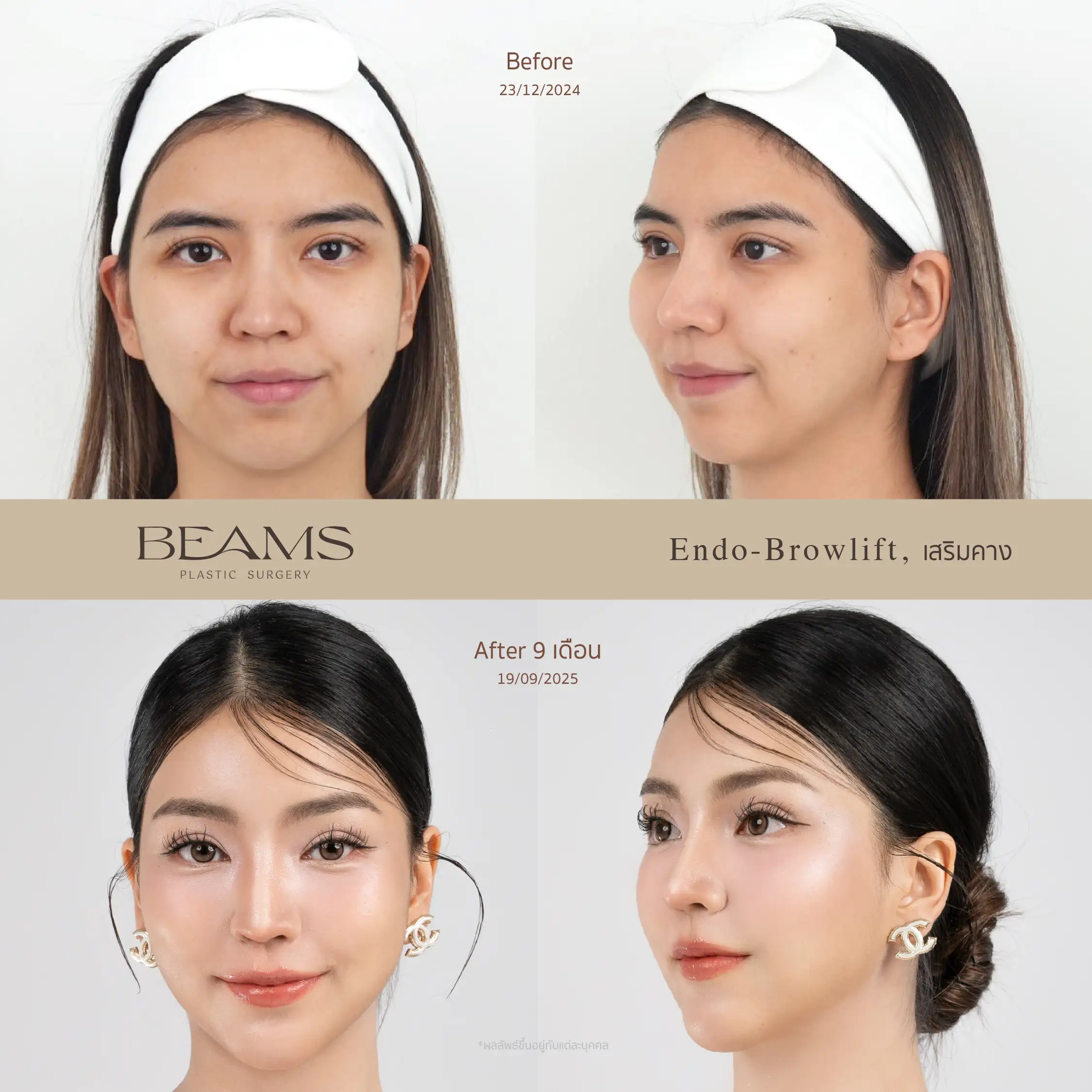 รีวิวยกคิ้ว Endotine