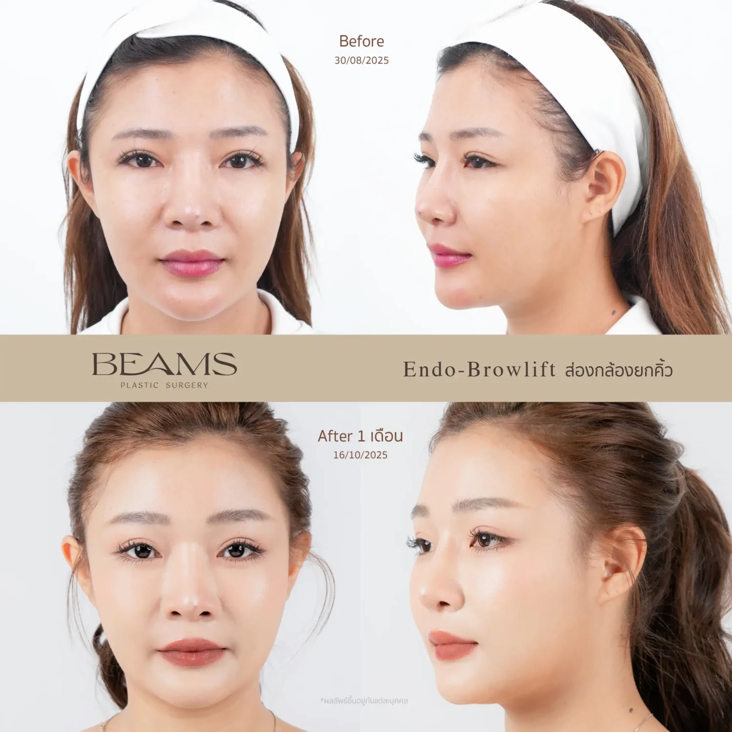 รีวิวยกคิ้ว Endotine