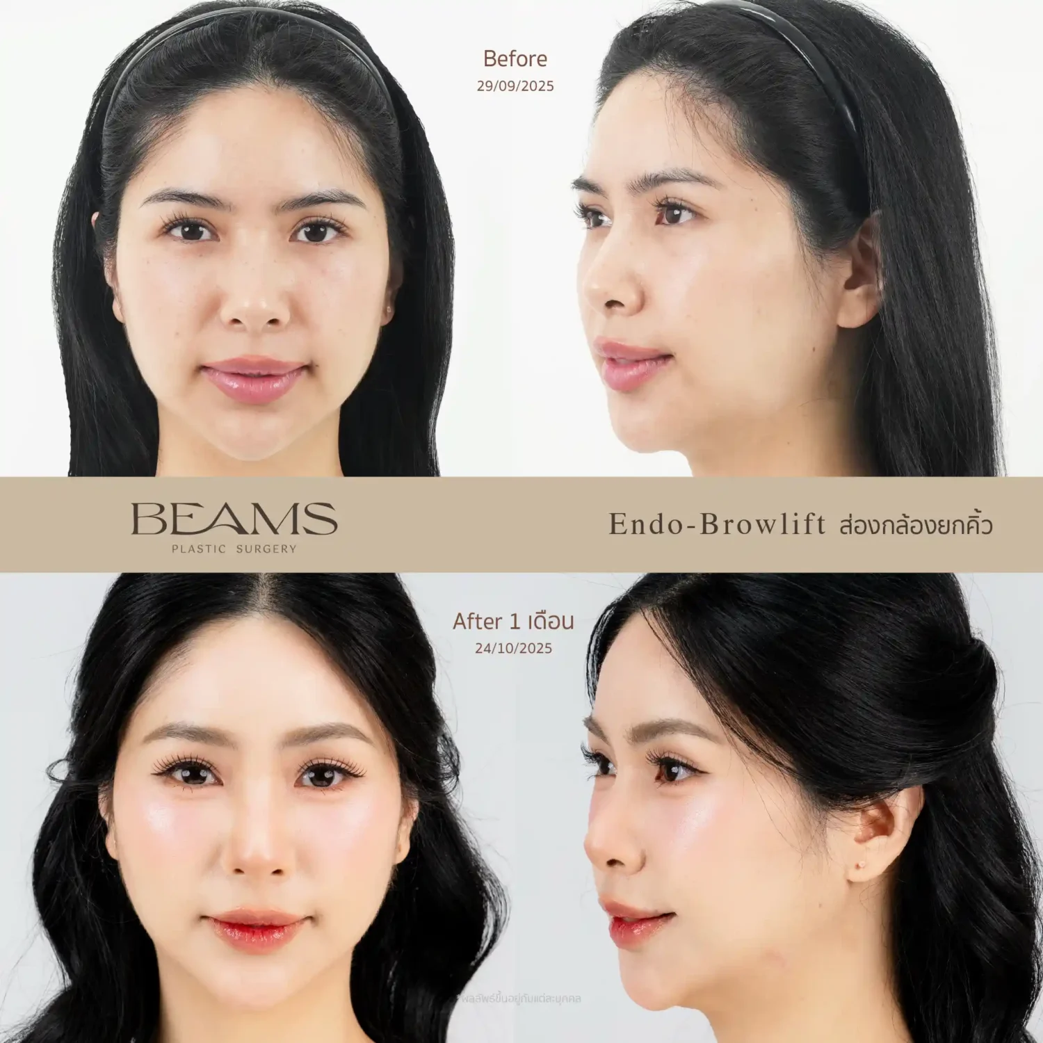 รีวิวยกคิ้ว Endotine