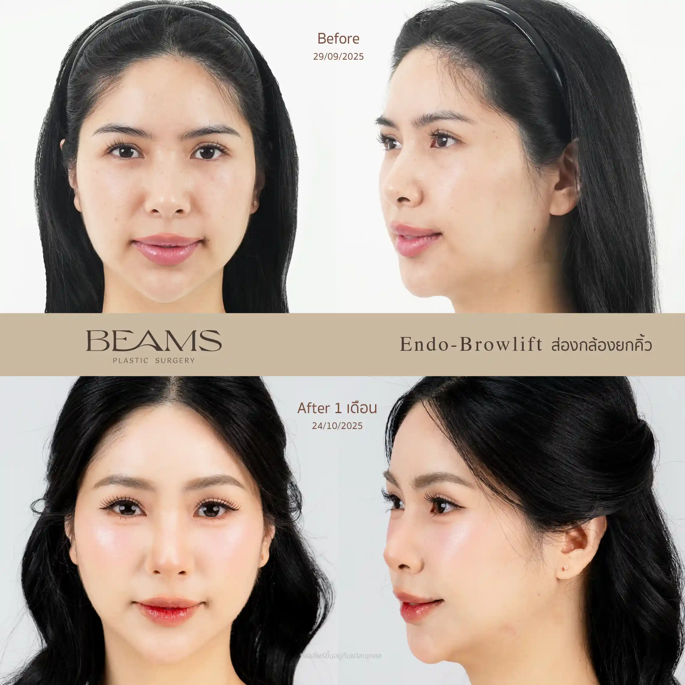 รีวิวยกคิ้ว Endotine