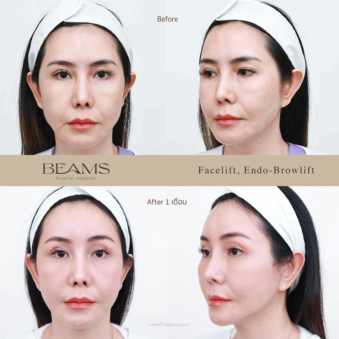 รีวิวดึงหน้า