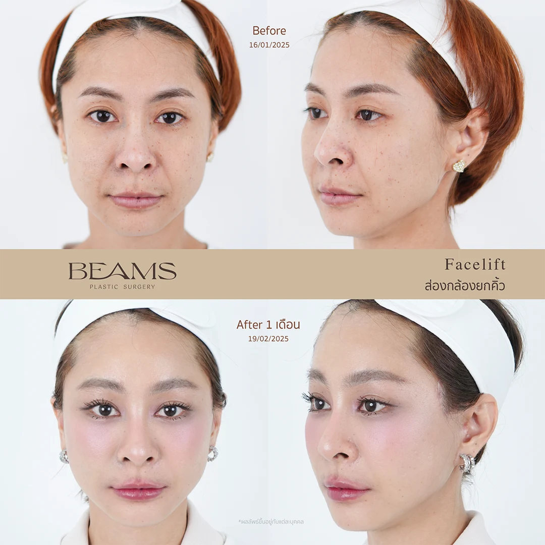 รีวิวดึงหน้า