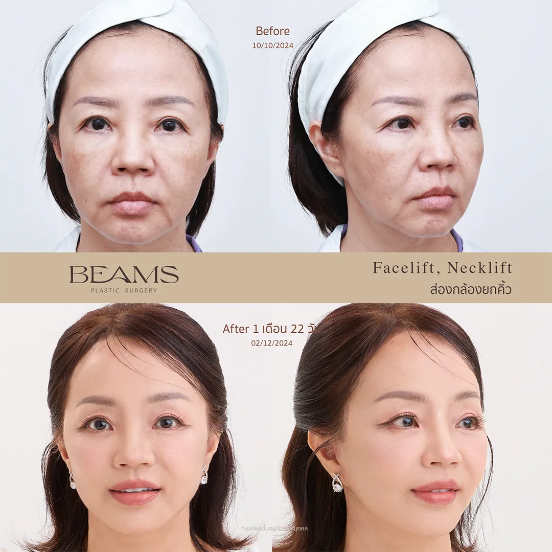 รีวิวยกคิ้ว Endotine