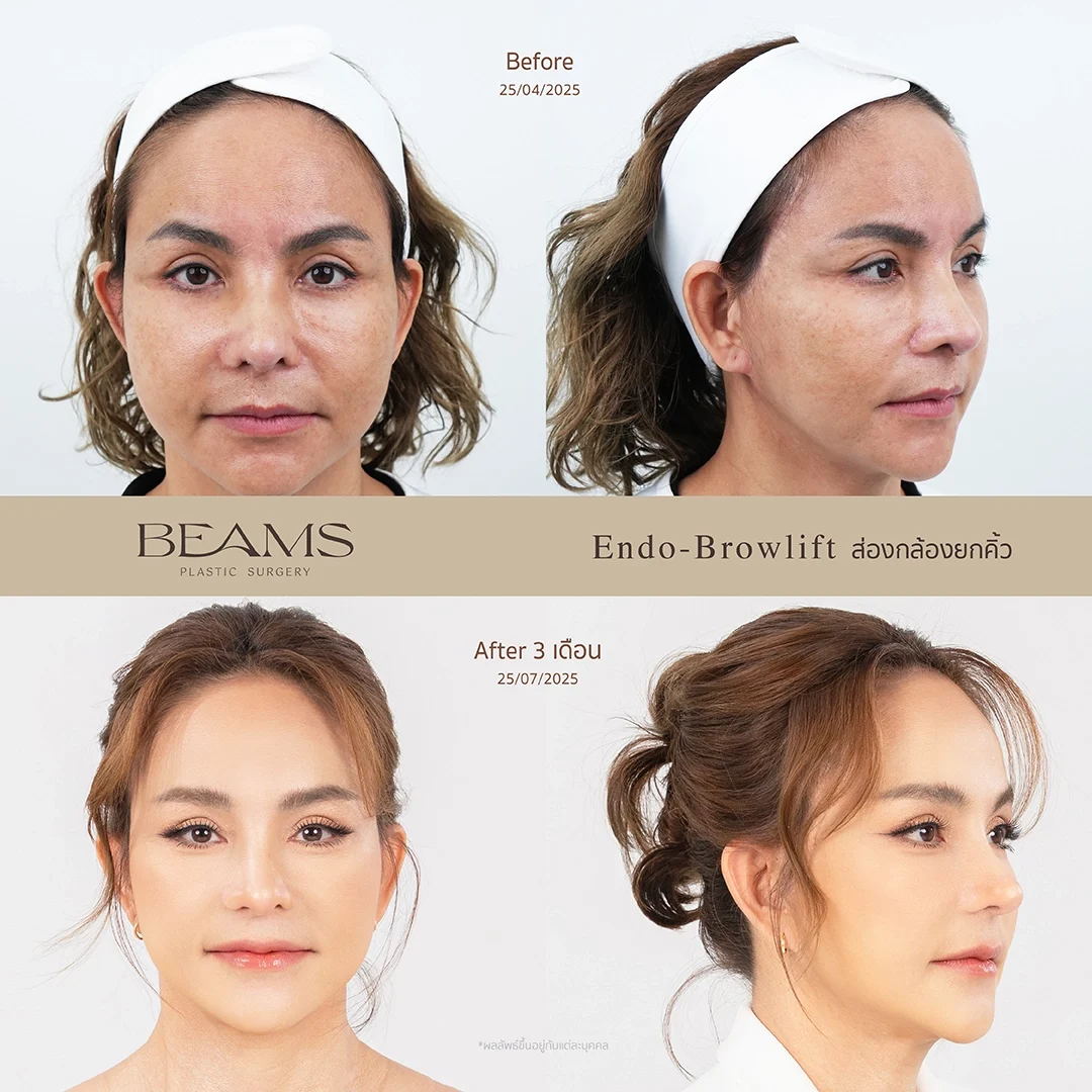 รีวิวยกคิ้ว Endotine