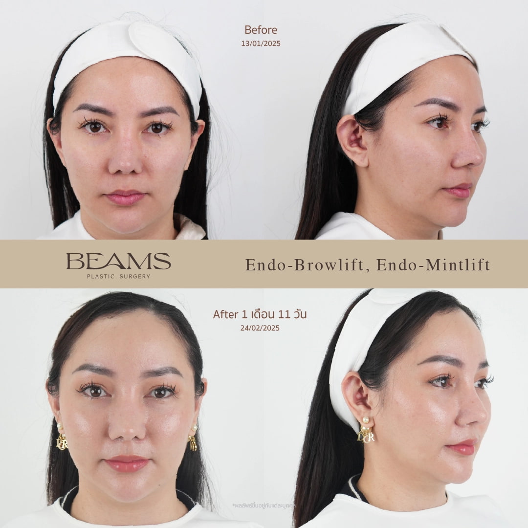 รีวิวยกคิ้ว Endotine