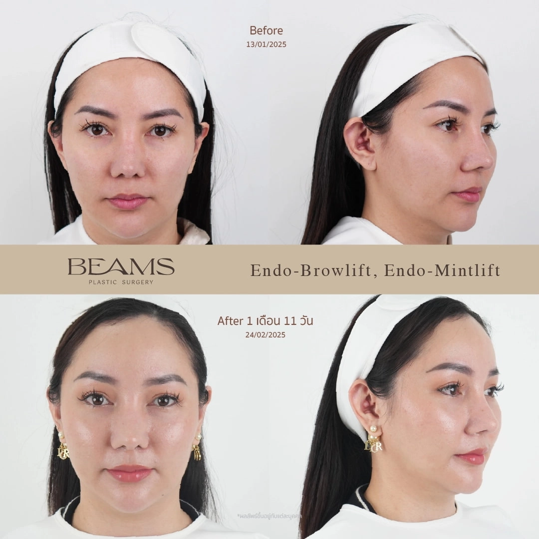 รีวิวยกคิ้ว Endotine