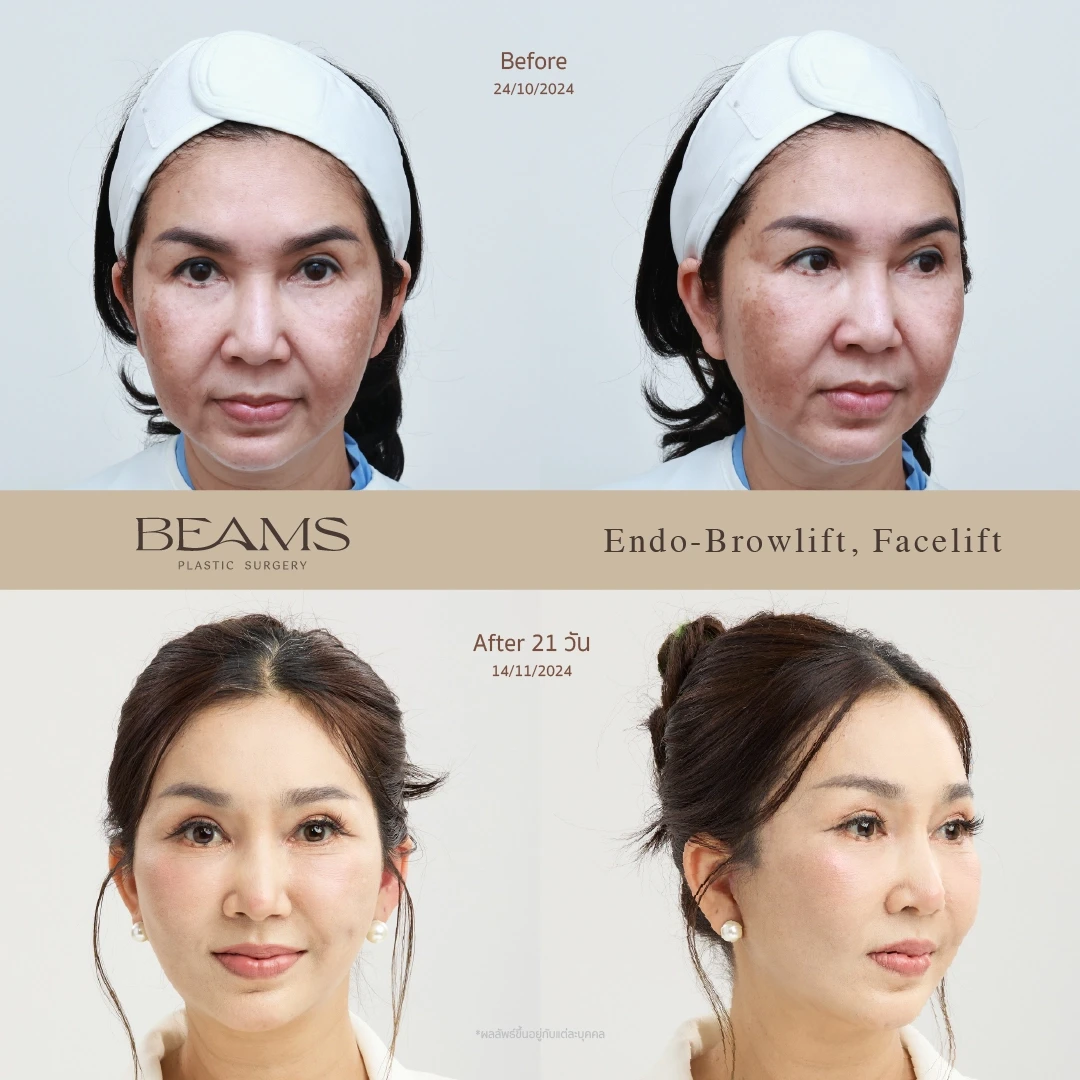 รีวิวดึงหน้า