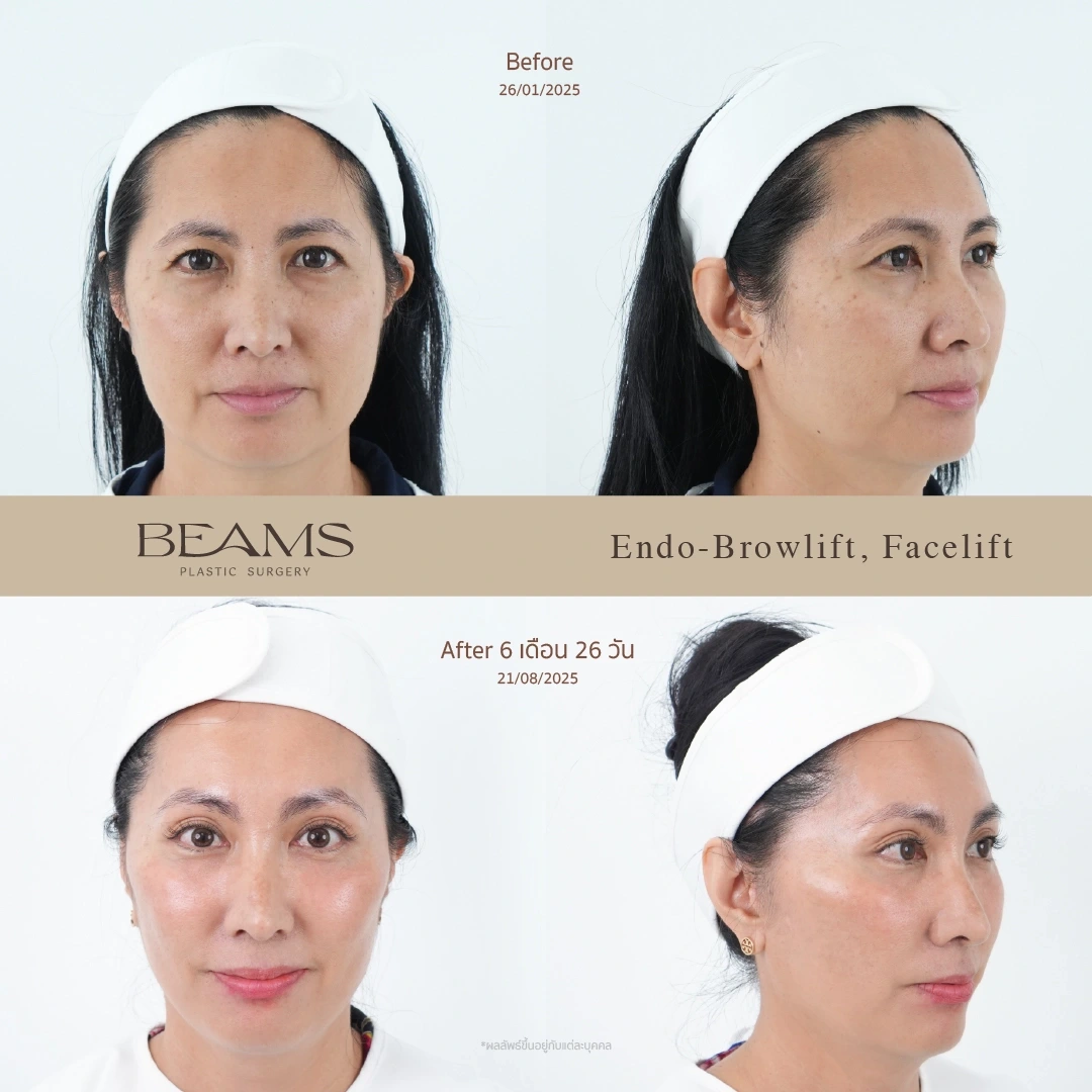 รีวิวดึงหน้า