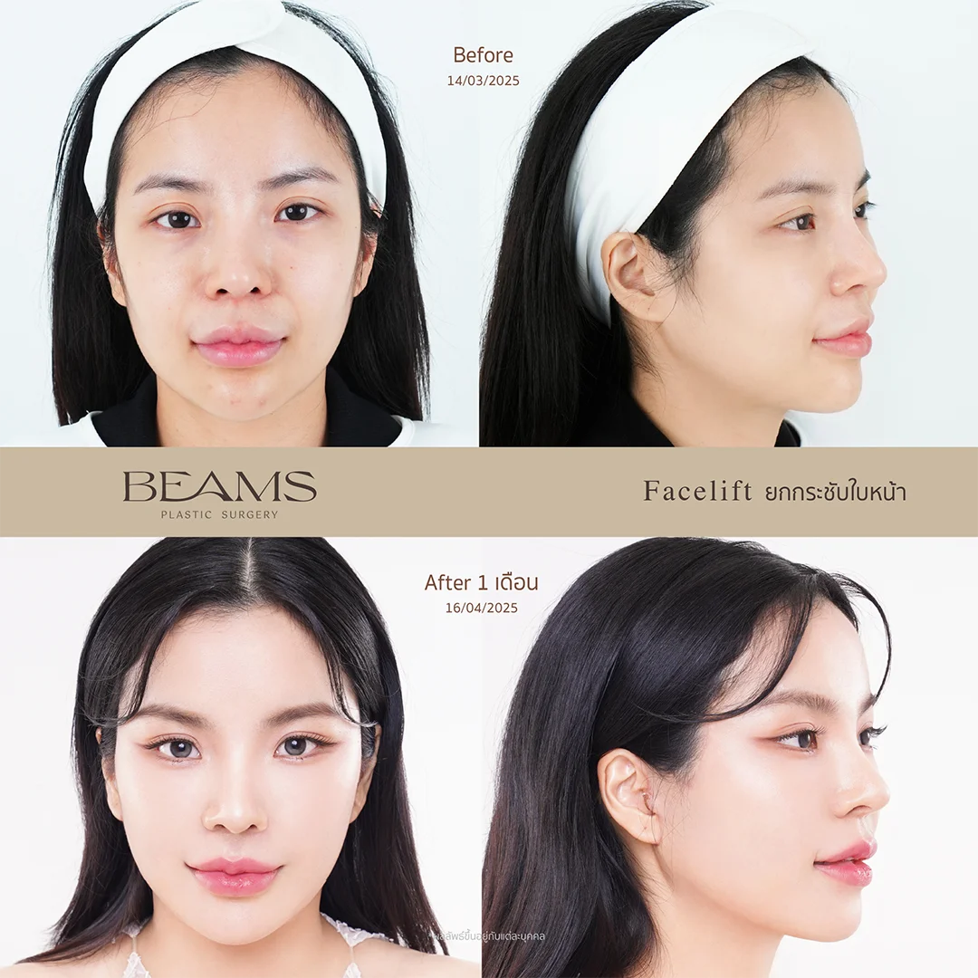 รีวิวดึงหน้า