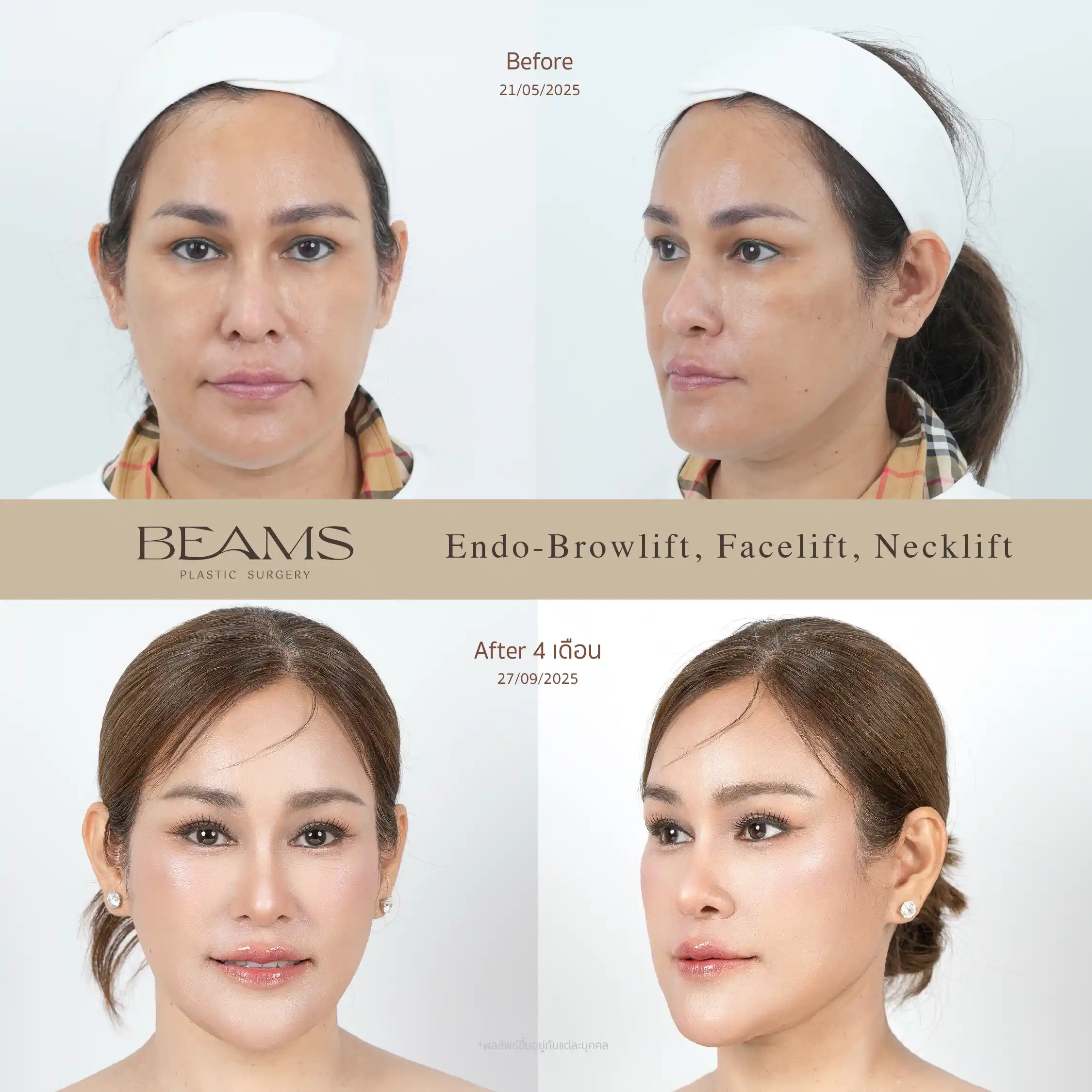 รีวิวดึงหน้า