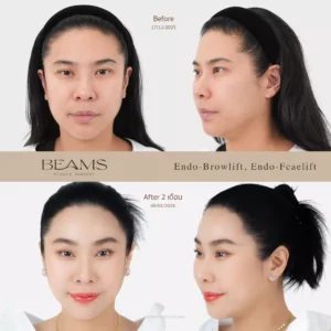 เคสรีวิวส่องกล้องดึงหน้า