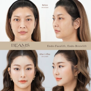 ส่องกล้องดึงหน้า รีวิว