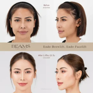 รีวิวส่องกล้องดึงหน้า