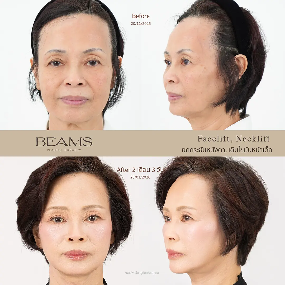 รีวิวคุณต้อม Subbrow lift