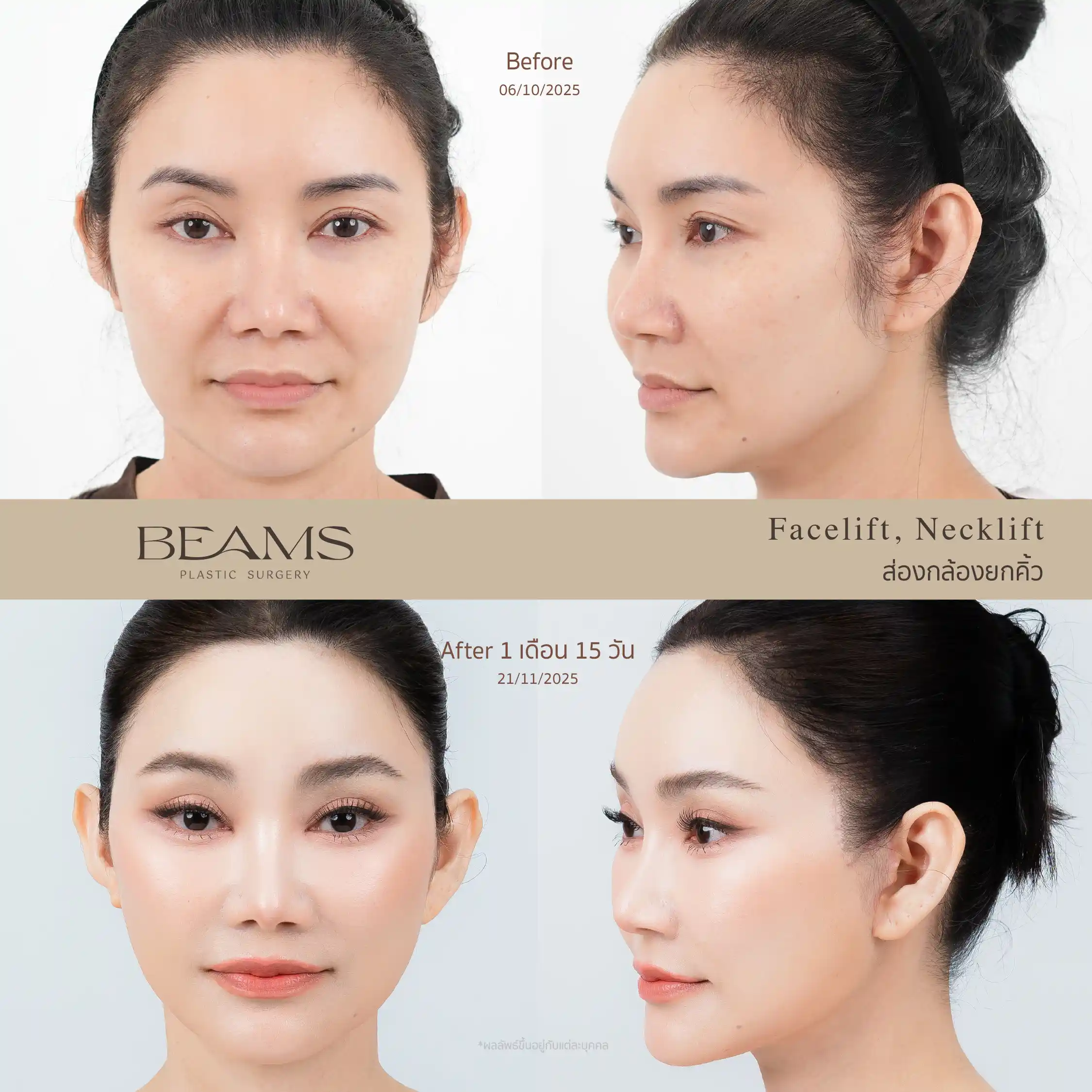 รีวิวดึงหน้า