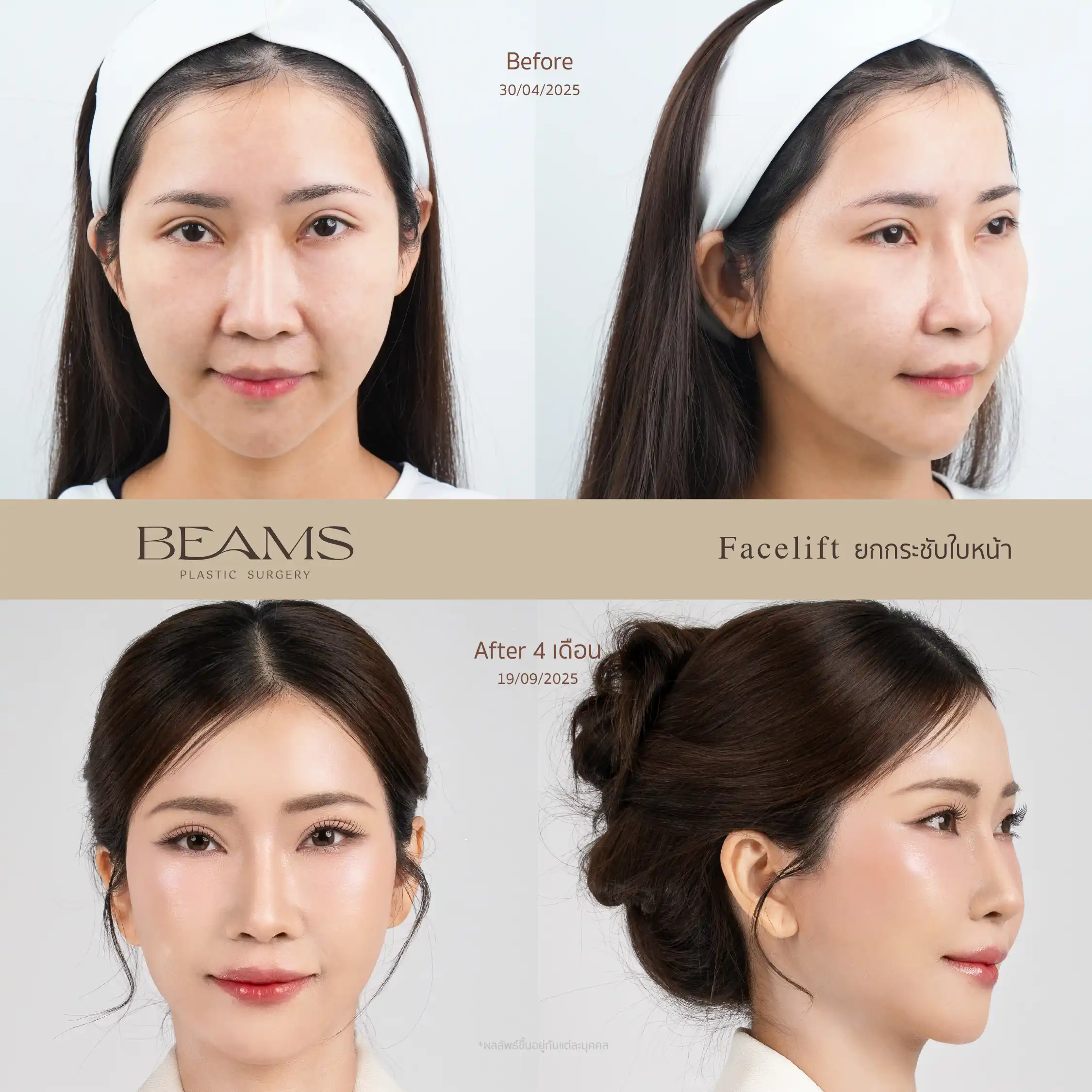 รีวิวดึงหน้า