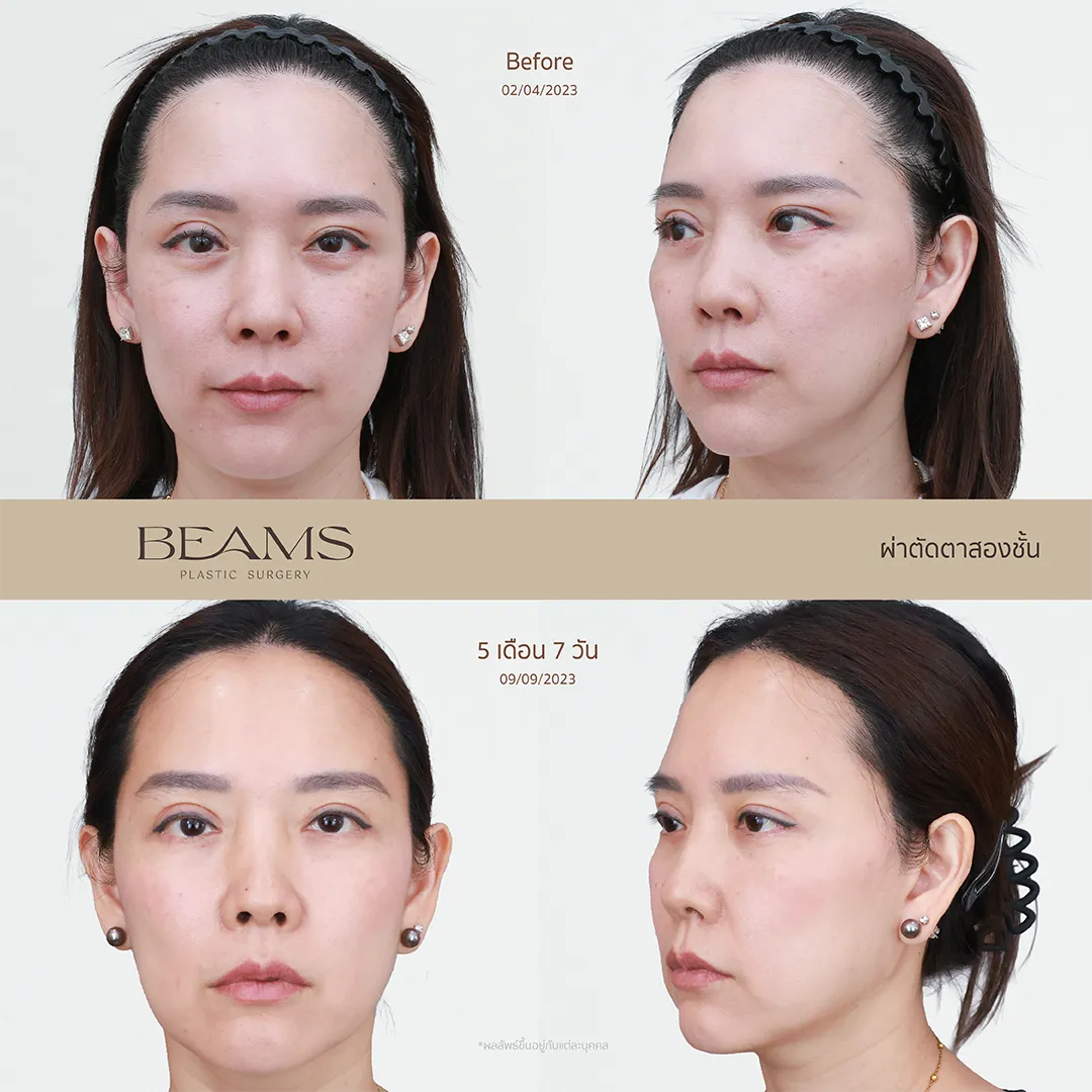 รีวิวทำตาสองชั้นคุณเอ๋