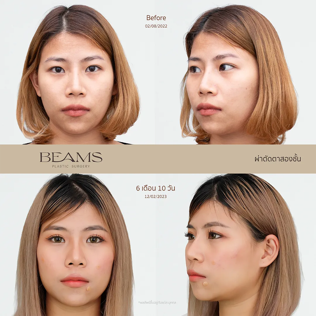 รีวิวทำตาสองชั้นคุณจอย