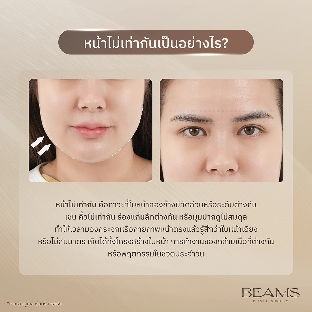 อาการหน้าไม่เท่ากัน