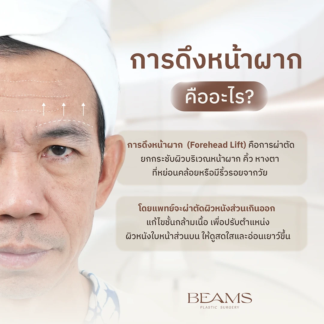 ดึงหน้าผากคืออะไร