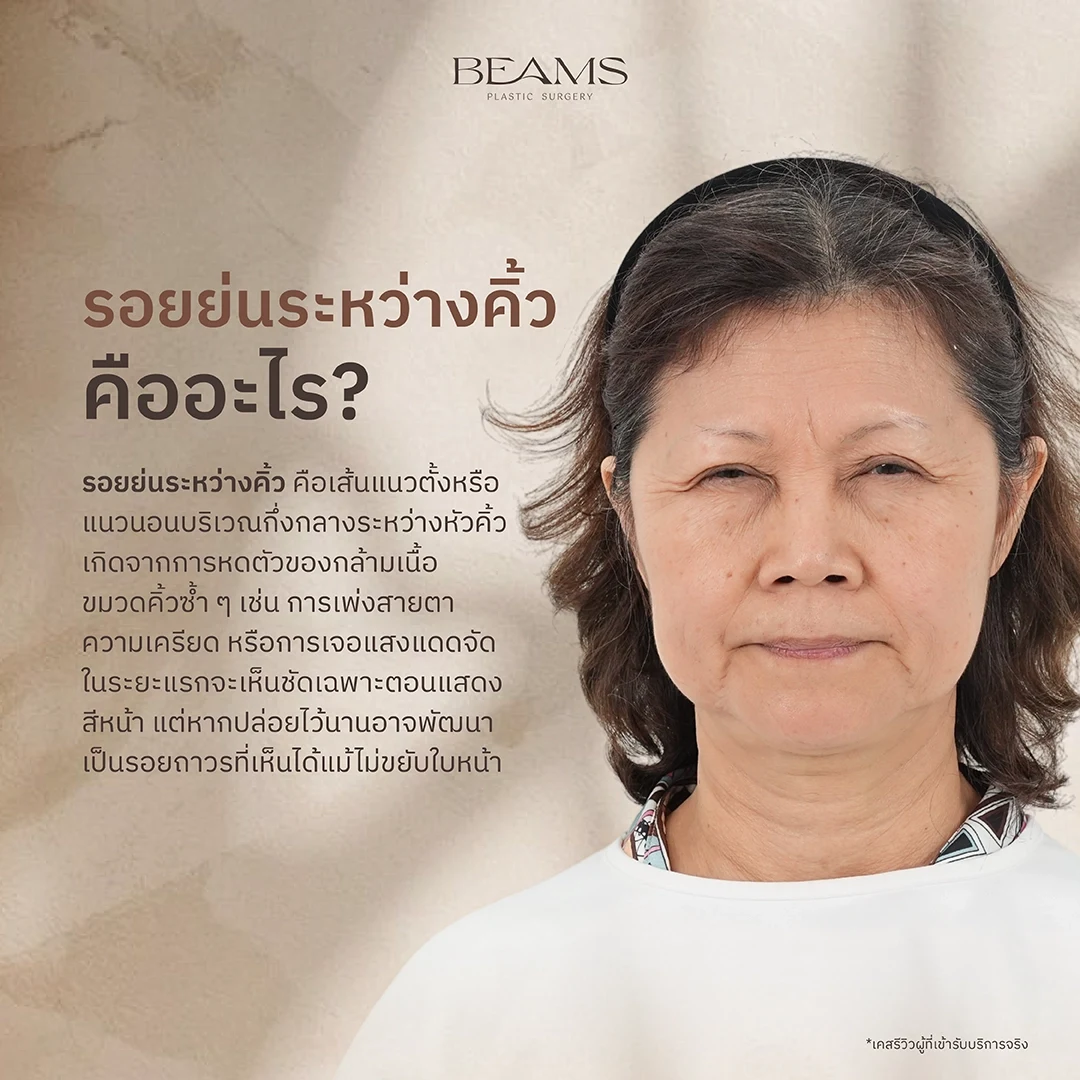 รอยย่นระหว่างคิ้ว คืออะไร