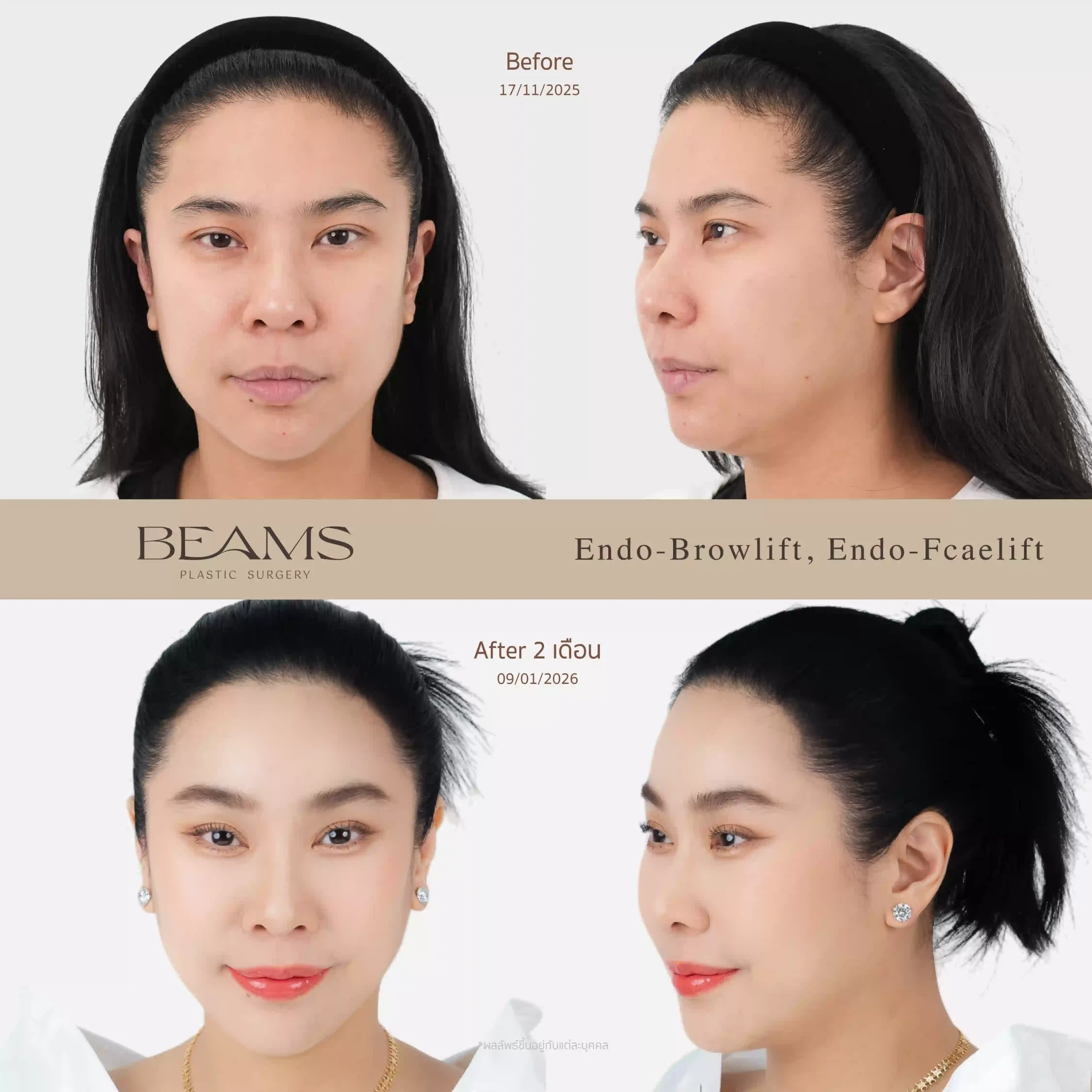 รีวิวศัลยกรรมส่องกล้องดึงหน้า