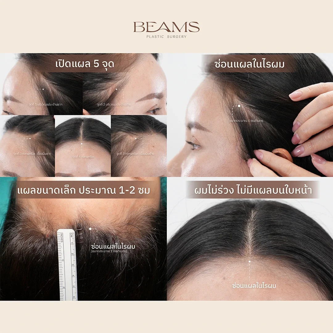 รูปแผล endo-browlift