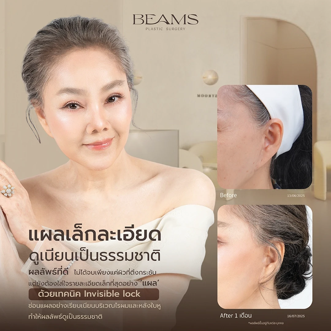 แผลของการดึงหน้า