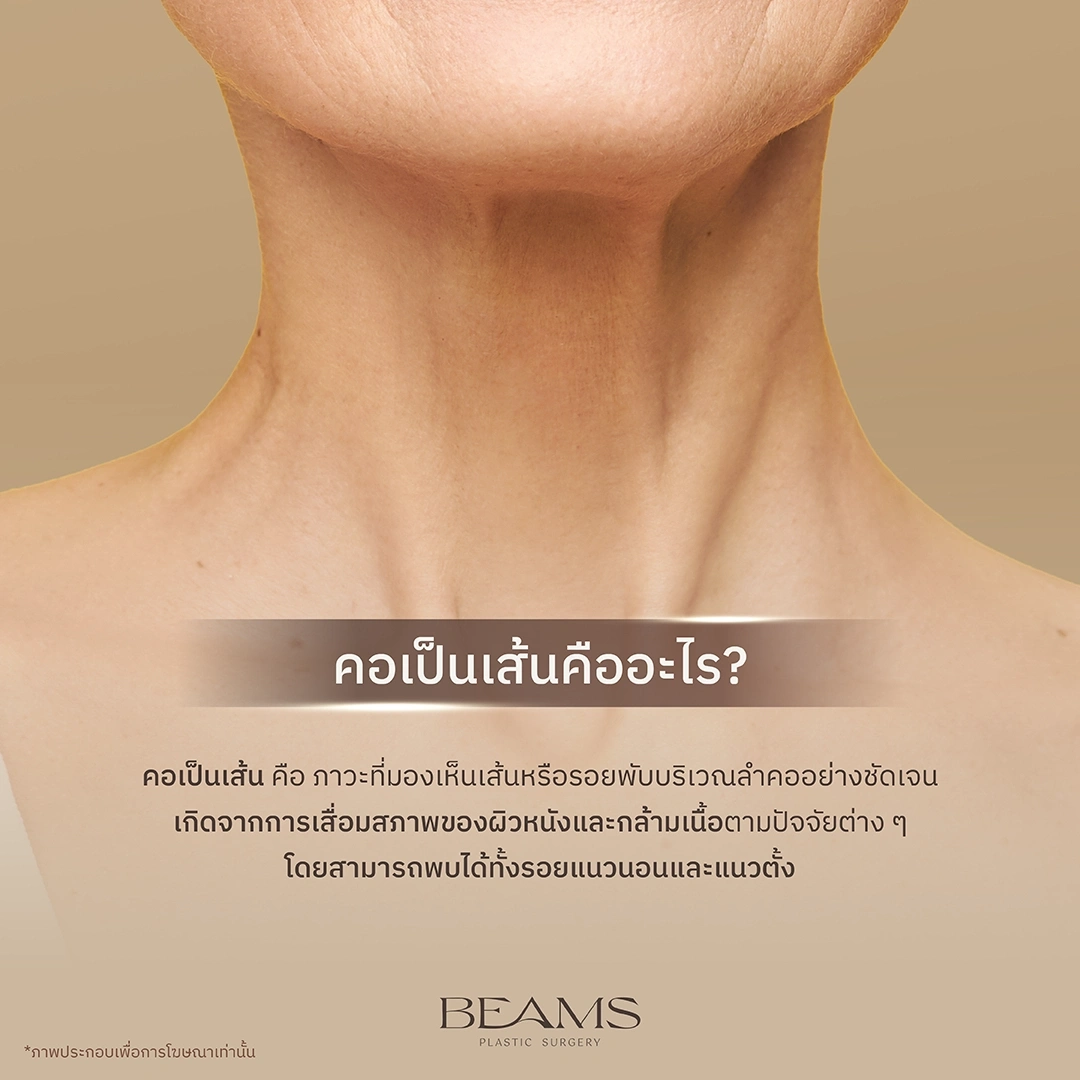 คอเป็นเส้น คืออะไร