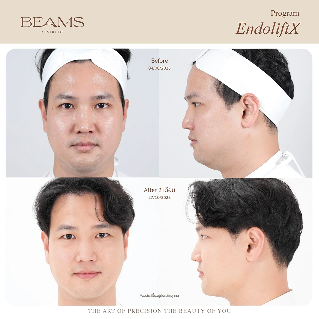 รีวิวทำ endolift