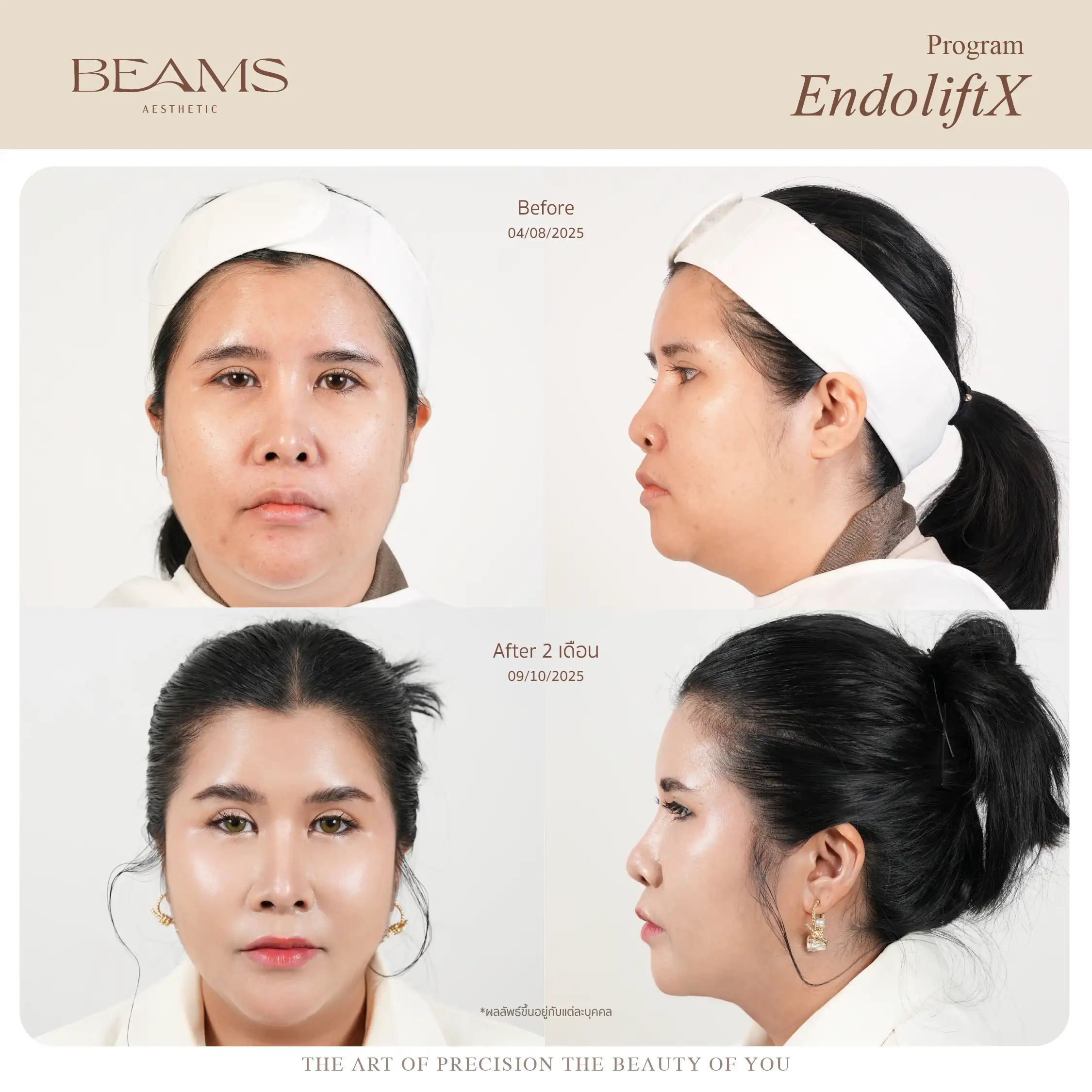 รีวิวการทำ endolift