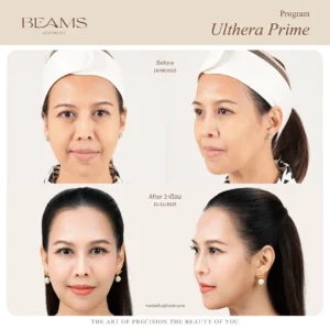 รีวิวโปรแกรม Ulthera คุณกุสุมา