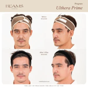 รีวิวโปรแกรม Ulthera คุณอติล่า