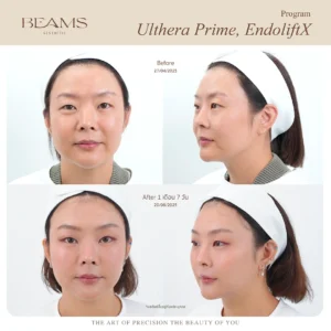 รีวิวโปรแกรม Ulthera คุณลุลา