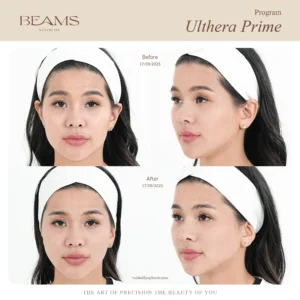 รีวิวโปรแกรม Ulthera คุณอ้อน