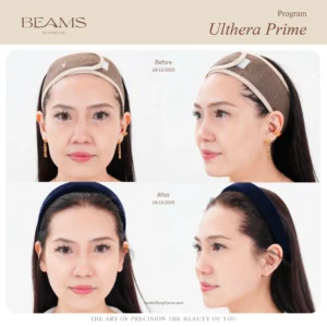 รีวิวโปรแกรม Ulthera คุณบอลลูน