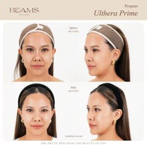 รีวิวโปรแกรม Ulthera คุณบูม