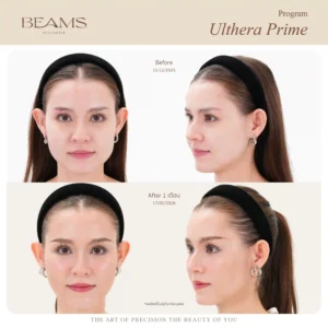 รีวิวโปรแกรม Ulthera คุณแก้มใส