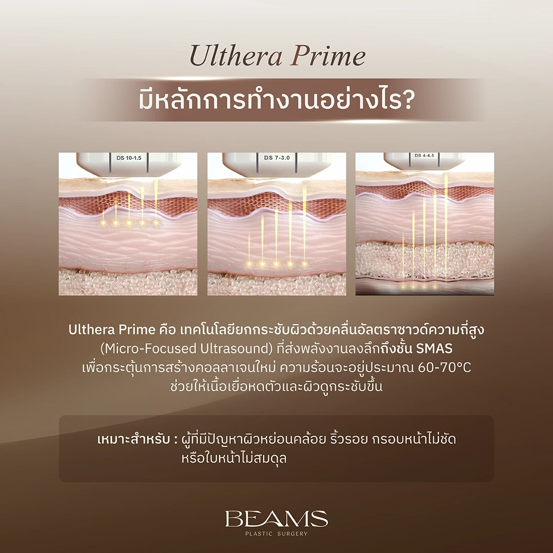 หลักการทำงาน Ulthera