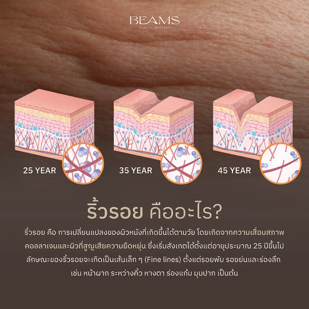 ริ้วรอย คืออะไร