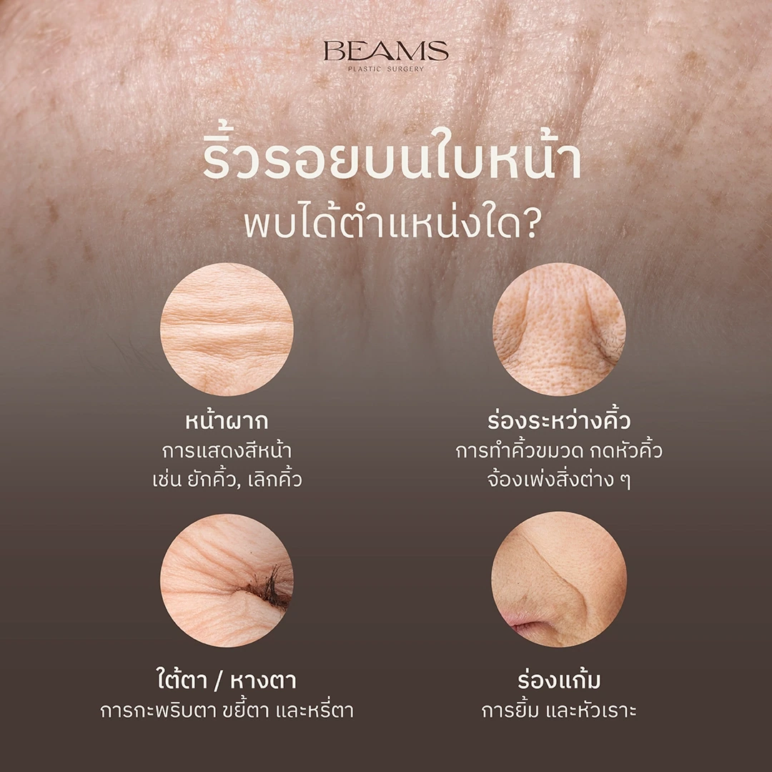 ริ้วรอยบนใบหน้าพบได้ตรงไหนบ้าง