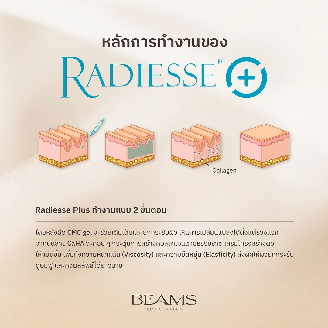 หลักการทำงานของ Radiesse Plus