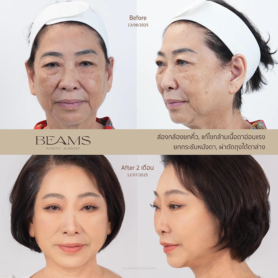 รีวิวผ่าตัดถุงใต้ตา