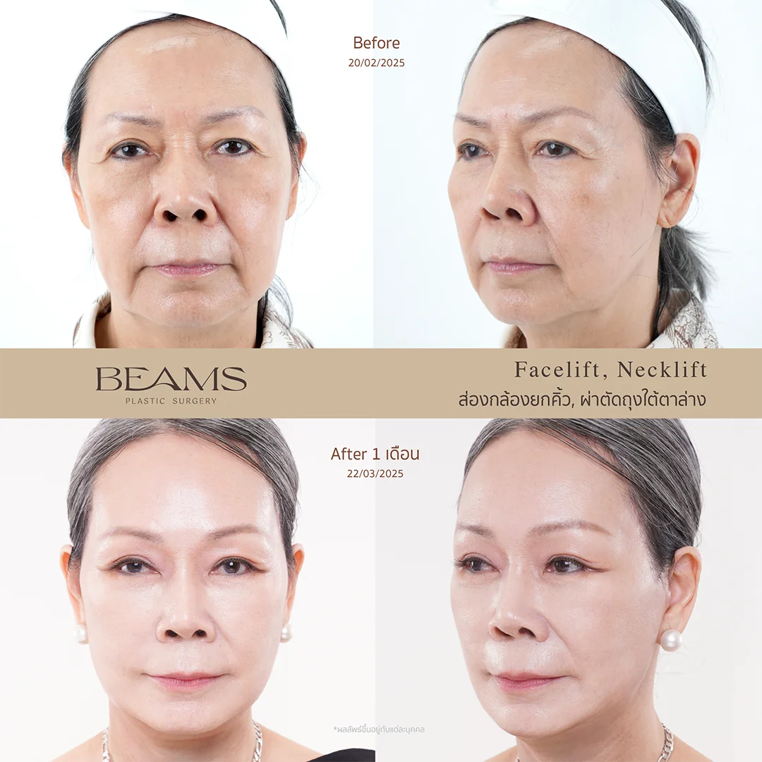 รีวิวผ่าตัดถุงใต้ตาล่าง