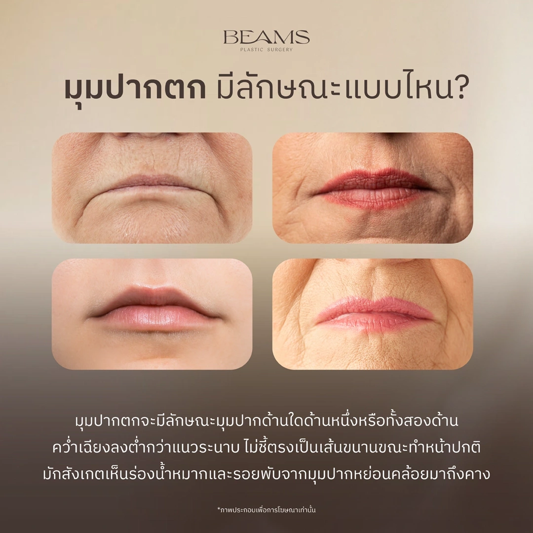 ลักษณะมุมปากตก