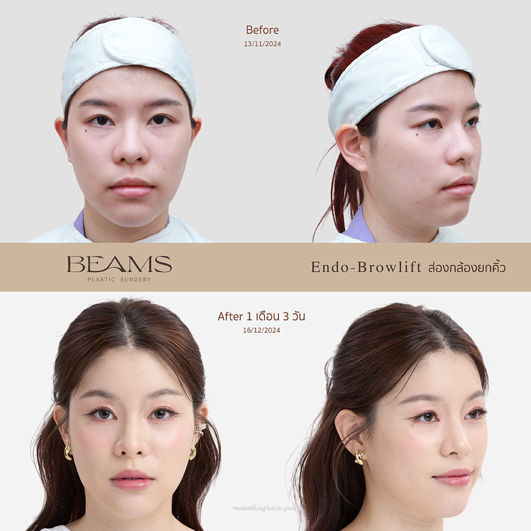 รีวิวยกคิ้วส่องกล้อง